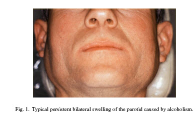 Sialosis / Sialadenosis5